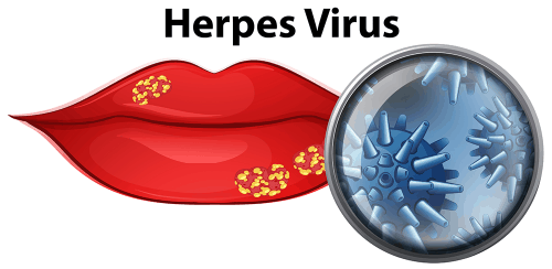 Herpes schnell loswerden